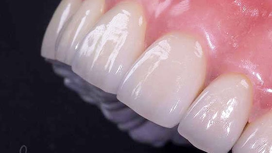 Empress Kaplama ve Empress Diş Fiyatları